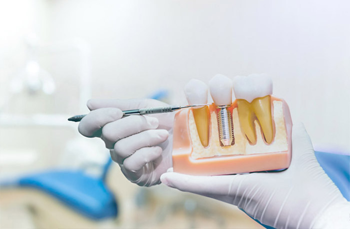 fachthema_periimplantitis